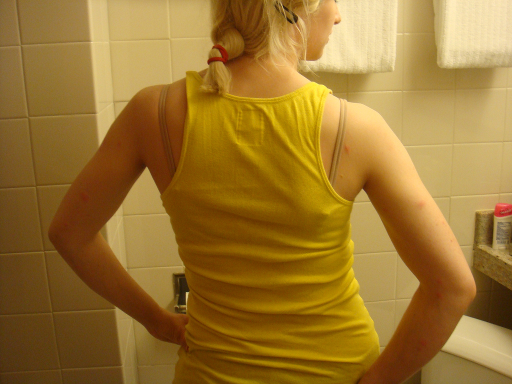 Eaten alive by mosquitos! by Debs (ò‿ó)♪ back pain photo