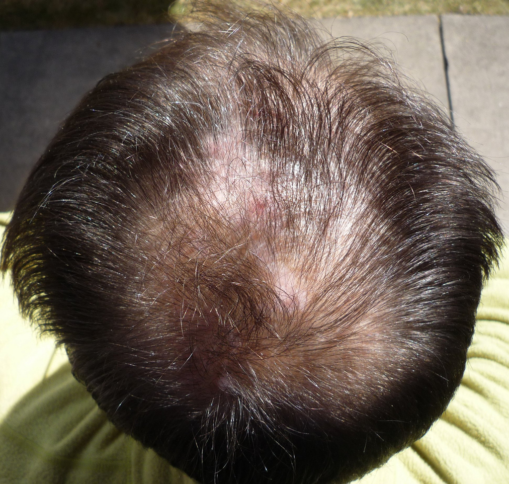 5682560791_66d644b6ce_b_bald-spot